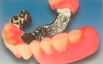 Zahnprothese