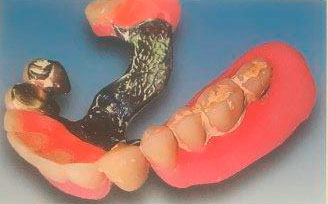 Zahnprothese